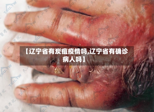 【辽宁省有炭疽疫情吗,辽宁省有确诊病人吗】-第2张图片